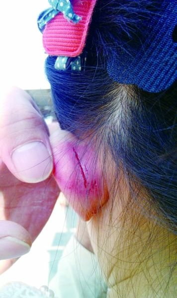 　　女童的耳朵被老師揪裂。圖片由女童家人提供