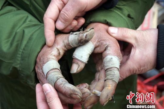 圖為由于常年拾荒，老人雙手布滿傷口。周小云 攝