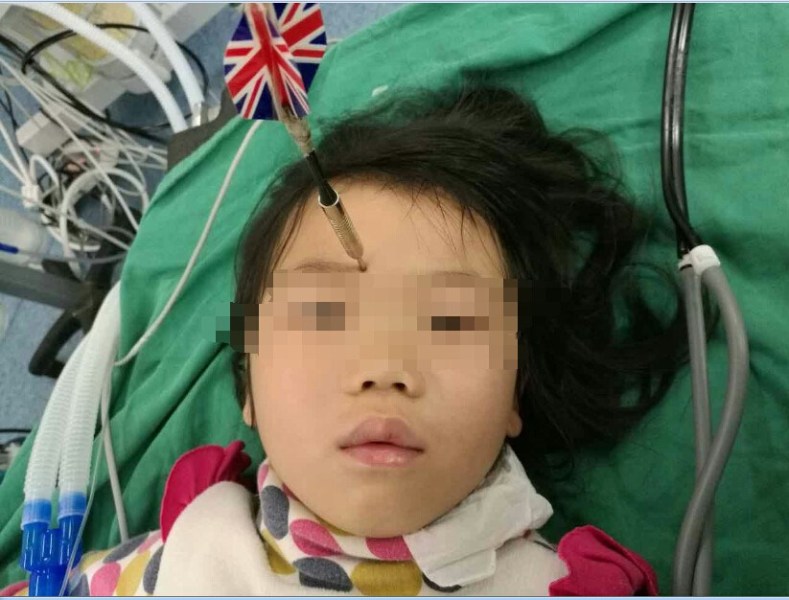 十多公分長(zhǎng)的飛鏢穩(wěn)穩(wěn)地 ” 定 ” 在了一名六歲半的女童額頭上，小青一家人凌晨從長(zhǎng)順趕到貴醫(yī)附院急診室時(shí)，看到如此慘烈的情況，接診醫(yī)生都嚇了一跳。詳細(xì)詢問下得知，原來是七歲的哥哥和六歲半的表妹在玩耍時(shí)，哥哥不慎將路邊撿來的真飛鏢扎到了妹妹的額頭上。