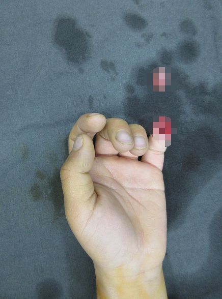 嚇哭！6歲男孩被夾斷手指 罪魁禍首竟是校服