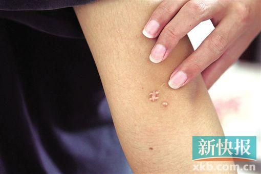 取出針后李星兒手臂留下了傷口。新快報(bào)記者 張國(guó)鋒/攝