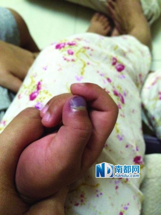 小逸手指被夾傷。